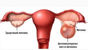 Kedy a v ktorý deň cyklu je lepšie urobiť ultrazvuk s cystou vaječníkov Ukáže ultrazvuk cystu