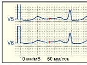 Que signifie la dépression du segment ST dans le déchiffrement d'un électrocardiogramme ?