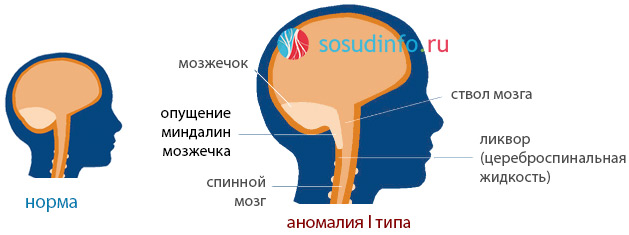 Мр картина низкого расположения миндалин мозжечка